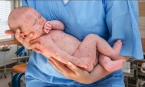 Više od 22 miliona beba propustilo prve vakcine: SZO upozorava na novu epidemiju morbila