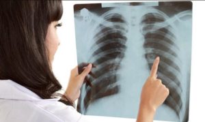 Ljudi sve češće na svoju ruku idu da snimaju pluća – radiolog upozorava na opasnost