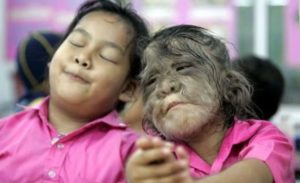 Djeca razvila „sindrom vukodlaka“ zbog pogrešne terapije
