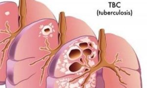 Nedjelja borbe protiv tuberkuloze