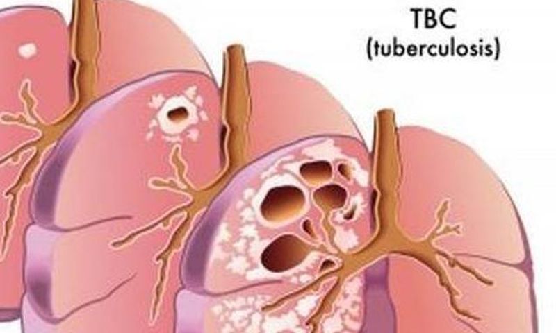 Broj oboljelih od tuberkuloze u Republici Srpskoj u značajnom padu