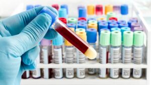 Istraživanje otkrilo: Efikasnije liječenje zaraženih koronom uz pomoć krvne plazme vakcinisanih