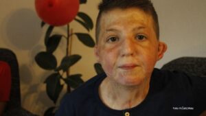 Nadljudska snaga jednog dječaka: Meho Beton hrabro prošao kroz 18 operacija i ima jaku poruku