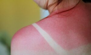 Ublažite neugodne bolove: Evo šta trebate raditi kada izgorite na suncu