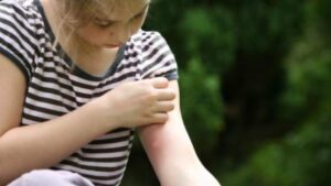 Roditelji treba da znaju: Zaštitite djecu od uboda insekata, evo kako