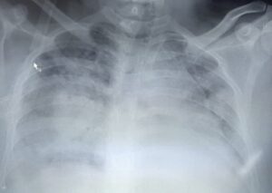 Kako zaraza utiče na čovjeka: Hirurg objavio snimak pluća pacijenta koji je umro od posljedica korone FOTO
