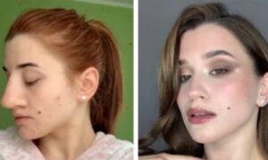 Kakva transformacija: Djevojka pokazala izgled nakon operacije nosa