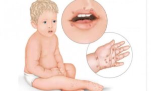 Pedijatar uvjerava! Virus koji napada dlanove, tabane i usta djece nije razlog za brigu