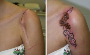 Medicinske tetovaže sve popularnije: Kriju ožiljke i ukazuju na bolest