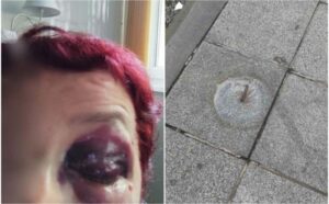 Žena zapela za armaturu i umalo izgubila oko: “Javašluk” nadležnih za dlaku platila glavom