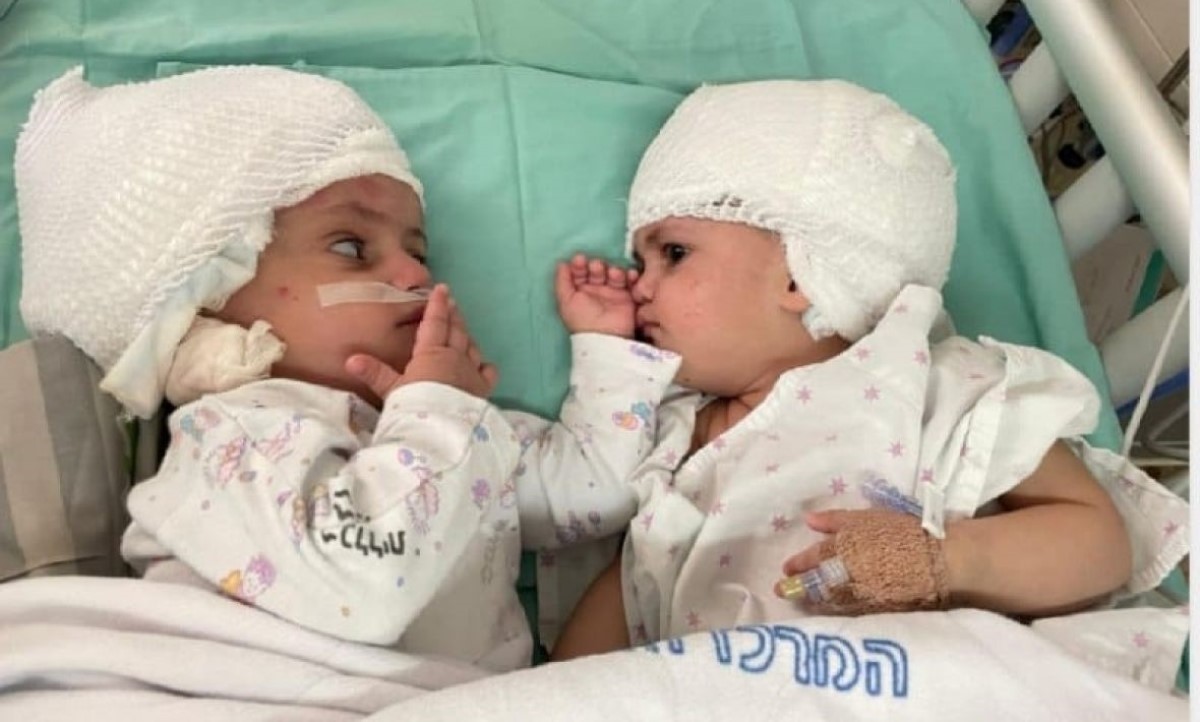 Emotivno! Uspješno razdvojene sijamske bliznakinje, sestrice se vidjele prvi put VIDEO, FOTO