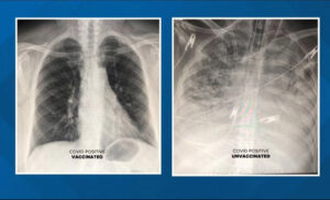 Jasna razlika! Kako izgledaju pluća vakcinisanih, a kako nevakcinisanih “korona pacijenata”