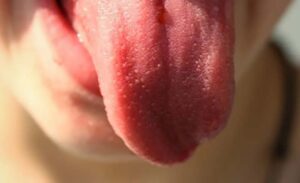 Ne zanemarujte: Male bijele tačkice na jeziku upozoravaju na veoma opasnu bolest