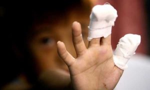 Amputiran mu prst: Djetetu petarda eksplodirala u ruci