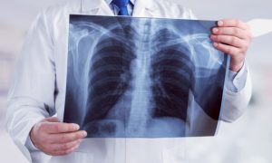 SZO: Tuberkuloza u snažnom porastu nakon godina opadanja