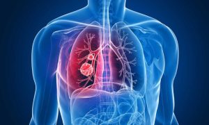 Porazna činjenica: Pacijenti trpe simptome raka pluća, a bolest napreduje