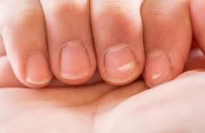 Obratite više pažnje: Šta znače bijele mrlje na noktima?