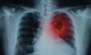 Osam ranih znakova pokazuju da imate rak pluća