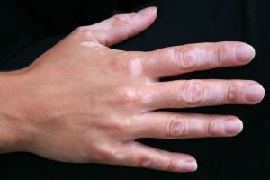 Vitiligo – nije zarazan i ne boli, naslijeđe nije jedina predispozicija bolesti