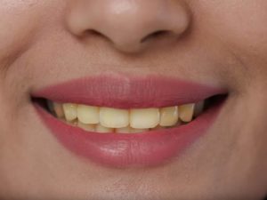 Šest razloga zbog kojih zubi postaju žuti
