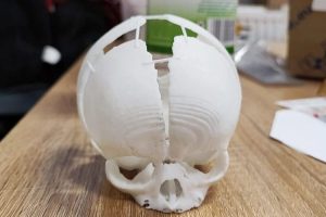 Hirurzi uspjeli spasiti bebu: 3D printerom napravljen dio lobanje