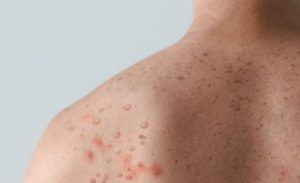 Muškarac pozitivan na koronu, HIV i majmunske boginje istovremeno