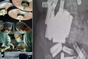 Otkrivene zahvaljujući rendgenskom snimku: Hirurzi iz stomaka žene izvadili više od 50 baterija