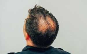 Ćelavost postaje prošlost: Naučnici otkrili tehniku od koje raste nova kosa