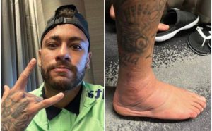 Brazilci zabrinuti: Nejmar pokazao kako izgleda njegov zglob nakon povrede FOTO