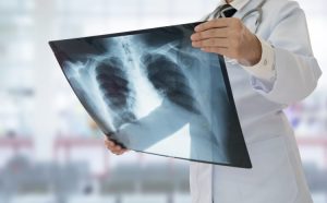 Rezultati istraživanja pokazali: Zagađen vazduh značajno povećava rizik od raka pluća