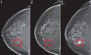 Nova umjetna inteligencija: Otkriva rak dojke godinama prije nego što se razvije