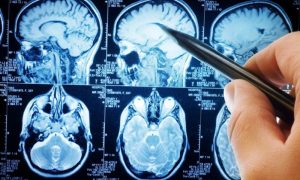 Žena sa dijagnozom tumora mozga upozorava: Ove simptome ignorisala