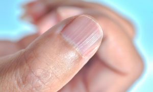 Obratite više pažnje: Ovo su simptomi raka koji se javljaju na noktima
