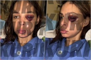 Nataša Šavija nakon operacije: Krvarim iz oka, jezivo je