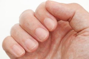 Nije potreban skup lijek: Kako da se riješite gljivica na noktima