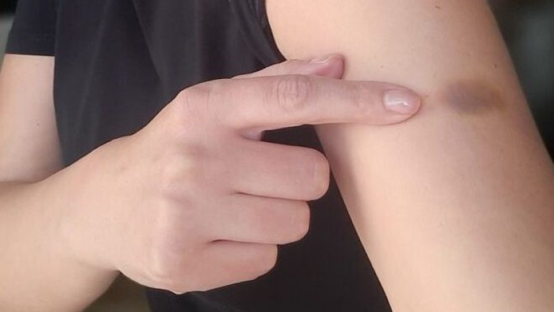 Ako stalno dobijate modrice: Kada je vrijeme za paniku?