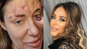 Doktor se oglasio povodom stanja Ane Nikolić: Objasnio uzrok rana na licu, pa pomenuo drogu