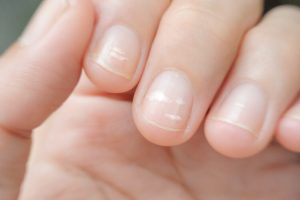 Bijele mrlje na noktima mogu da budu simptom ozbiljnih bolesti
