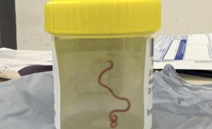 Šokantan slučaj! Ljekari u mozgu žene pronašli živog crva od osam centimetara