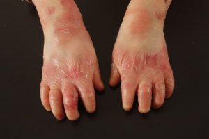 Najteža kožna bolest: Revolucionarni lijek za “djecu leptire” dogodine