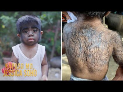 Dječak ima “sindrom vukodlaka”: Njegovo cijelo tijelo prekriveno je dlakama VIDEO