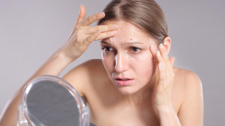 Muku mučite sa aknama: Kroz nekoliko jednostavnih trikova riješite problem