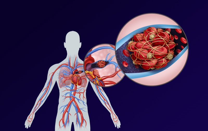 Glavni simptom se vidi na nozi: Plućna embolija odnese više života od infarkta