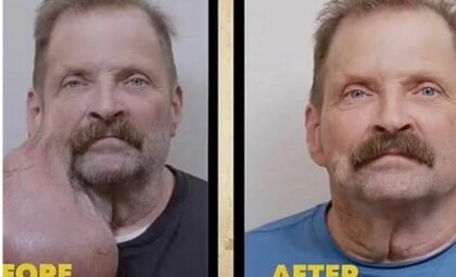 Nakon operacije – drugi čovjek: Tim je 15 godina živio sa ogromnim tumorom na licu