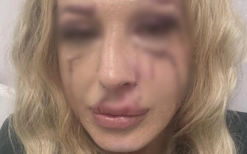 Radnici obezbjeđenja brutalno pretukli bračni par u kafani: Cijelo lice mi je popucalo i krvavo