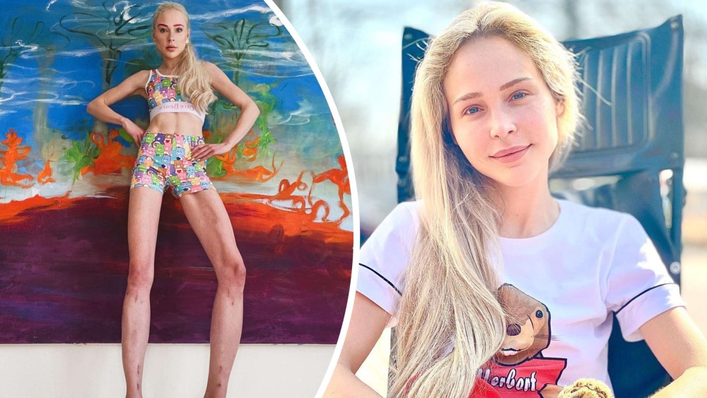 Trpi nesnosne bolove: Manekenka potrošila preko 150.000 evra da produži noge