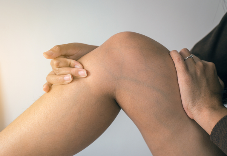 Estetski, ali i zdravstveni problem: Proširene vene nestaju za dvije nedjelje – samo utrljajte ovo