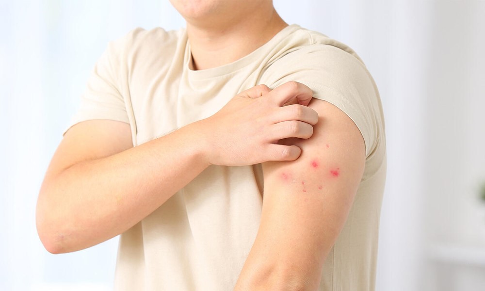 Najviše u Bijeljini: U Srpskoj morbilima zaraženo 263 lica