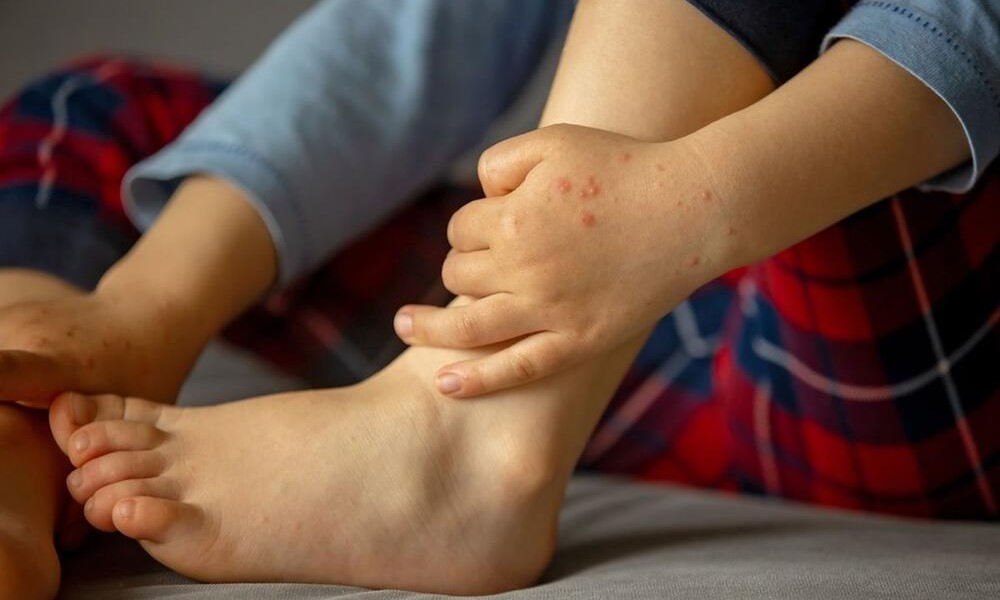 Koksaki virus ovih dana ponovo brine roditelje: Ovo su prvi simptomi da se trebate javiti doktoru