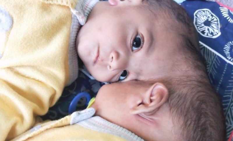 Bliznakinjama više nisu spojene glave: Operacija trajala 14 sati, sestrice uskoro slave 1. rođendan FOTO